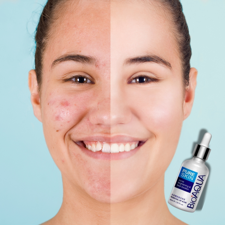 Suero Hidratante Antiacne Bioaqua