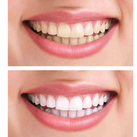 Kit blanquemiento dental (carbon 30gr)