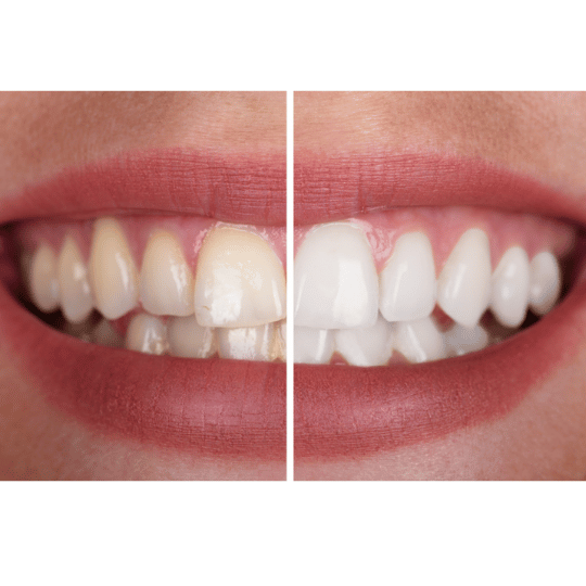 Kit Blanqueamiento Dental Profesional 20 Minutos
