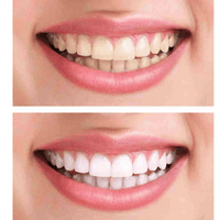 Kit Blanqueamiento Dental Profesional 20 Minutos