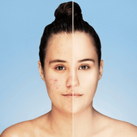 Serum Facial Antiacné de Ácido Salicílico Bioaqua